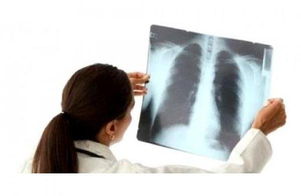 Як лікувати в домашніх умовах запалення легенів