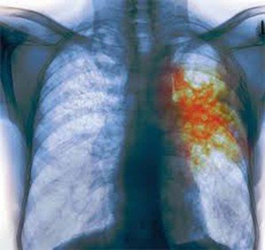 Лікування туберкульозу народними засобами