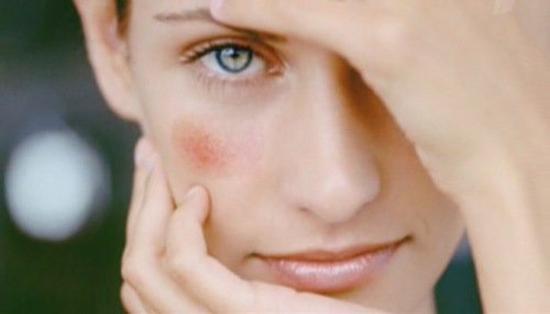 Види косметики від куперозу на обличчі й інші способи догляду