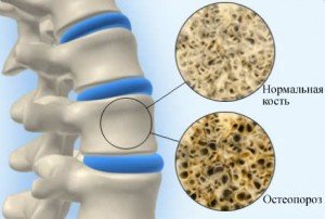 Лікування народними засобами остеопорозу