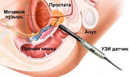 Як робиться ТРУЗД простати, правила підготовки і ціни на процедуру
