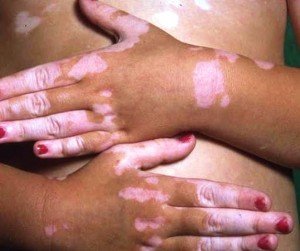 Лікування небезпечного шкірного захворювання Вітіліго народними засобами