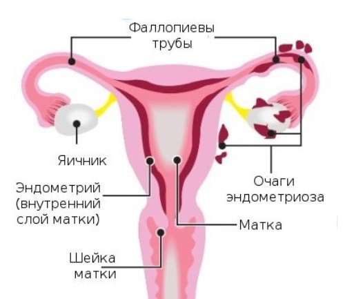 Чи можна завагітніти при ендометріозі і як це зробити