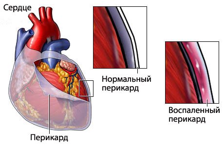 Перикардит у дітей: ексудативний, гнійний, фіброзний
