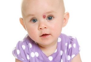 Лікування гемангіоми у дітей: лазер, кріодеструкція, гормони