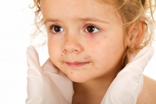 У дитини червоні прищики на обличчі й тілі: причини, види, лікування