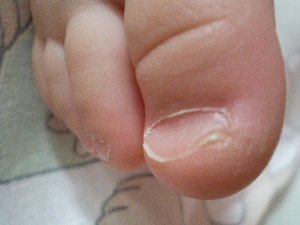 Грибок нігтів у дітей: чому зявляється, симптоми, як лікувати