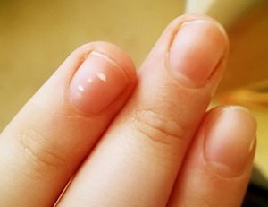 Чому у дитини зявилися білі плями на нігтях
