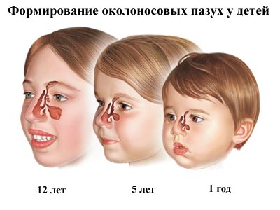 Синусит у дітей: симптоми і ознаки, види, лікування, профілактика