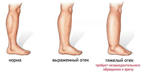Набряки ніг і промежини після пологів: причини, заходи, терміни, лікування