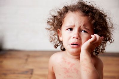 Хвороба Верльгофа — завжди синці у дітей нешкідливі?