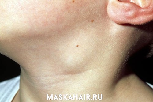 Шийний лімфаденіт – причини і лікування захворювання