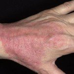 Атопічний дерматит: симптоми і лікування