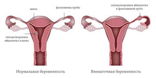 Позаматкова вагітність: як визначити, чому відбувається, методи лікування, наслідки