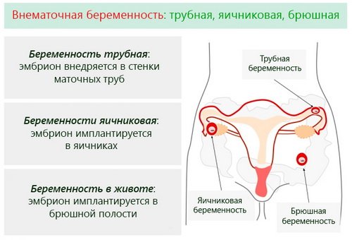 Позаматкова вагітність: як визначити, чому відбувається, методи лікування, наслідки