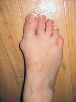 Практичні поради про те, як прибрати шишки на ногах. Фото до і після операції
