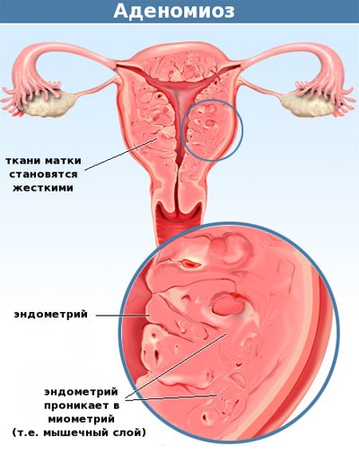 Як лікувати аденоміоз матки? Симптоми, ознаки та відгуки