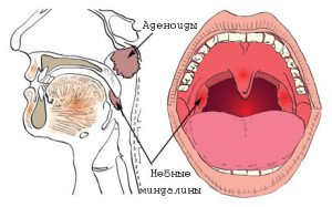 Біль в горлі: ангіна або тонзиліт?