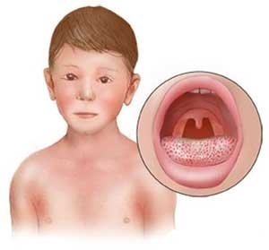 Характерні симптоми і правильне лікування гострого фарингіту у дітей
