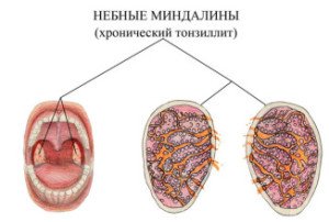Визначальні причини і патогенез тонзиліту