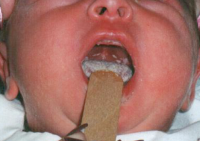 Симптоми і причини набряку горла або гортані у дітей