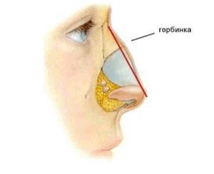 Як можна прибрати горбочок на носі без операції