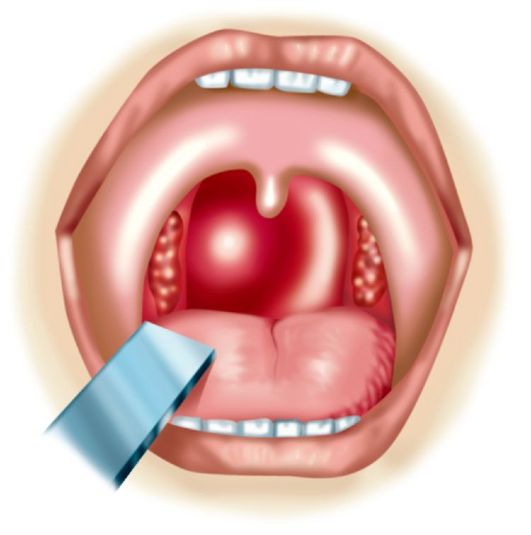 Способи лікування поліпів в горлі