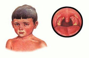 Секрети лікування ангіни у дитини в 2 роки