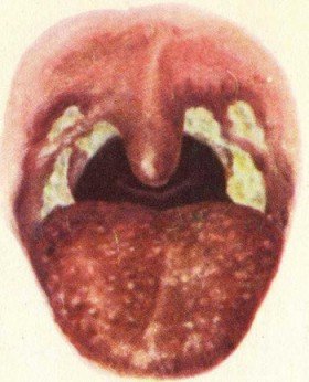 Що треба знати про стрептококке в горлі?