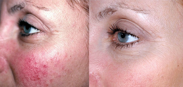 Фотоомолодження шкіри обличчя: процедура, відгуки та очікувані рецепт