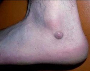 Фіброма на нозі: причини появи, лікування