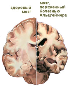 Хвороба Альцгеймера: симптоми прояву та лікування