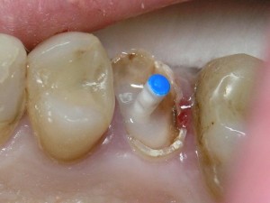 Нарощування зубів — секрети і особливості
