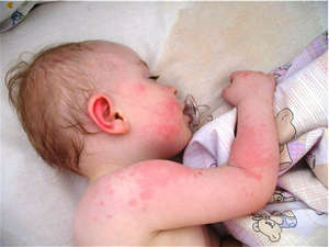Причини алергічної висипки у дитини