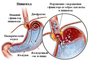 Причини появи езофагіту. Харчування при езофагіті