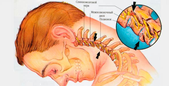 Біль у шиї ззаду ліворуч або праворуч — розбираємося, чому виникає біль