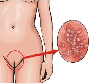 Генітальний герпес: лікування захворювання у жінок та чоловіків