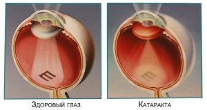 Катаракта ока: симптоми і лікування