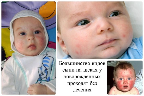 Причини і лікування висипу на обличчі у новонародженого