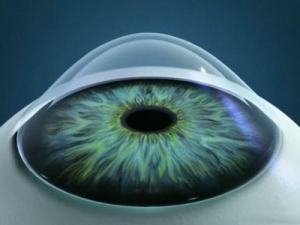 Лікування кератоконуса очі в домашніх умовах
