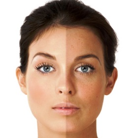 Фотостаріння шкіри — причини і лікування