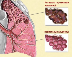Емфізема легень: ознаки і лікування народними способами