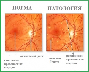 Ангіопатія сітківки ока: ознаки, типи і лікування
