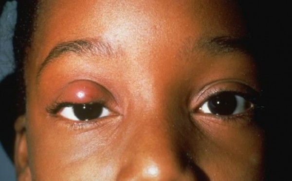 Якими ліками лікують ячмінь на оці