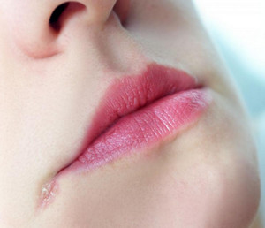 Методи боротьби з заїдами на губах