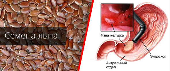 Лікування виразки шлунка за допомогою насіння льону
