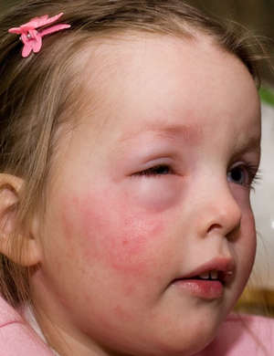 Причини алергічної висипки у дитини