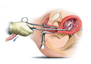 Як роблять вакуум аборт (міні аборт) — наскільки небезпечна дана операція
