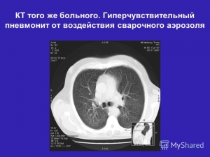 Алергічний альвеоліт легенів і його лікування