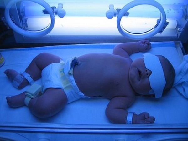 Чому у новонароджених буває жовтянка і як її лікувати?